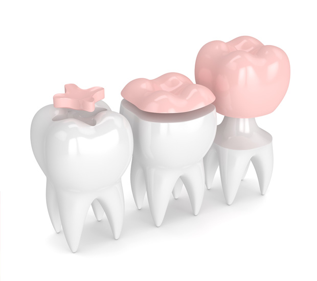 Santa Clarita Dental Inlays and Onlays
