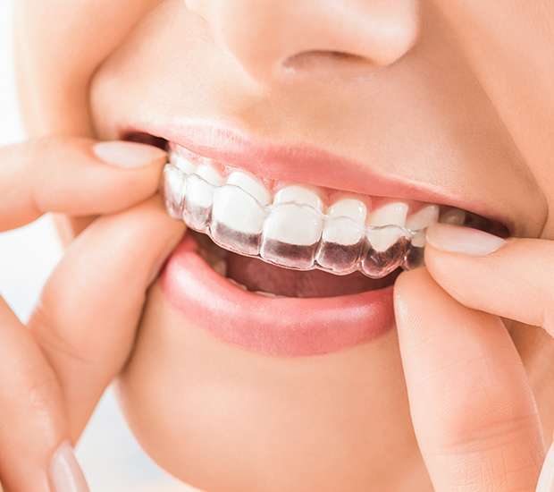 Santa Clarita Does Invisalign Really Work