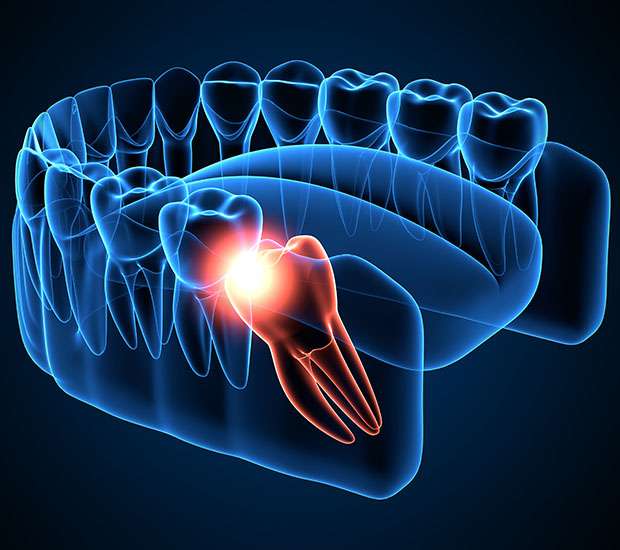 Santa Clarita Wisdom Teeth Extraction